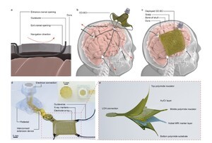 4mm 구멍으로 BCI 이식! 뇌-컴퓨터 인터페이스 최소 침습 수술 시대 개막